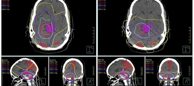 Функциональная магнитно-резонансная томография в состоянии покоя помогает выполнить тонкую настройку планов лучевой терапии мозга
