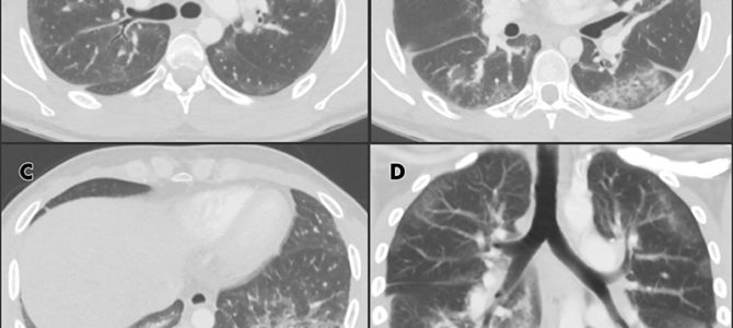 Случай поражения легких, вызванного вейпингом: разбор  для радиологов